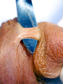 Frenulum Removed Circumcised Penises