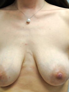 Saggy Tits - Breast Reduction 029