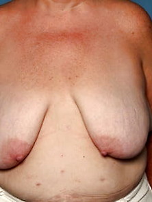Saggy Tits - Breast Reduction 024