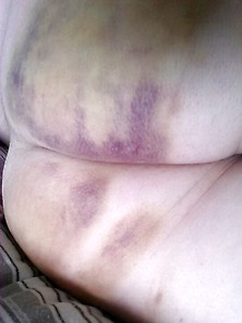 Marked And Bruised Cheating Wife.