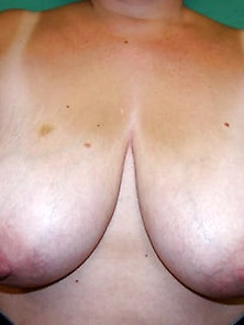 Saggy Tits-Breast Reduction 026