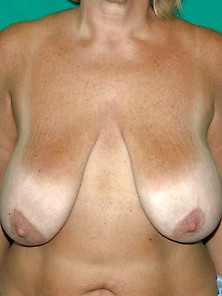 Breast Reduction-Specimen Gallery 002