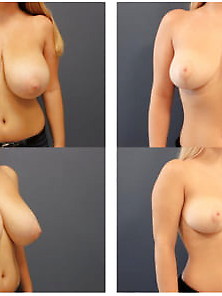 Breast Reduction Rip